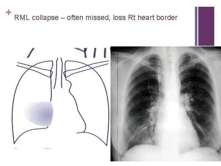 + RML collapse – often missed, loss Rt heart border 