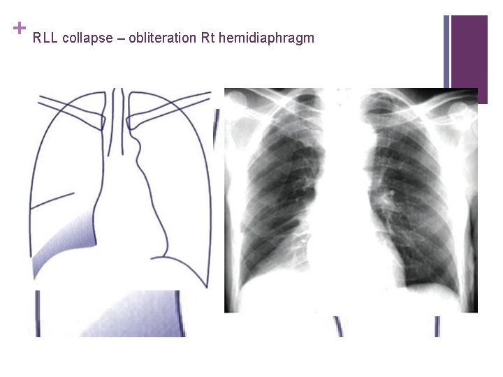 + RLL collapse – obliteration Rt hemidiaphragm 