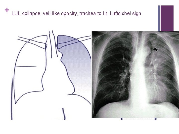 + LUL collapse, veil-like opacity, trachea to Lt, Luftsichel sign 