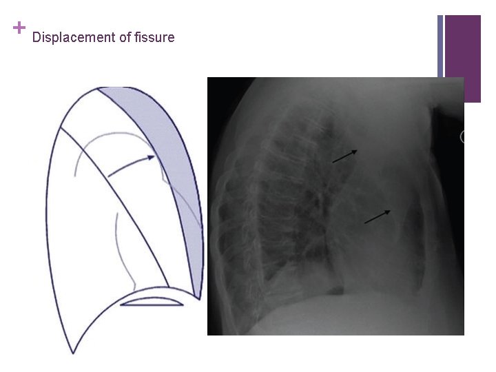 + Displacement of fissure 