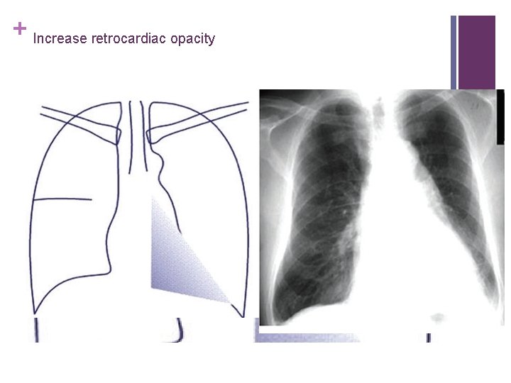 + Increase retrocardiac opacity 