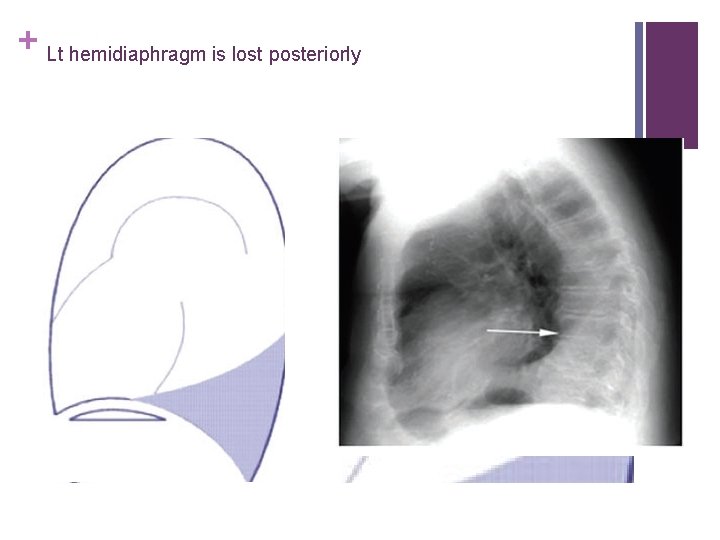 + Lt hemidiaphragm is lost posteriorly 