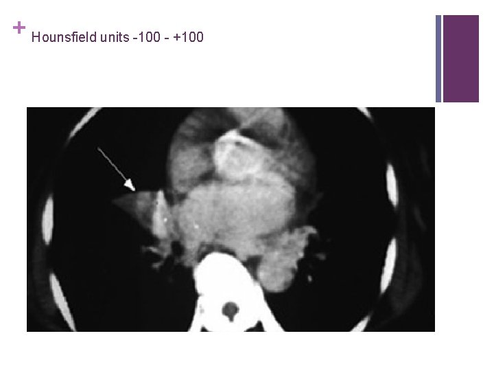 + Hounsfield units -100 - +100 