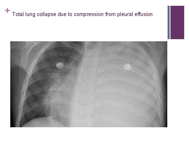 + Total lung collapse due to compression from pleural effusion 