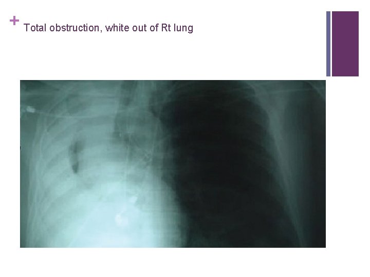 + Total obstruction, white out of Rt lung 