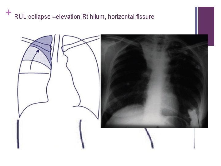 + RUL collapse –elevation Rt hilum, horizontal fissure 