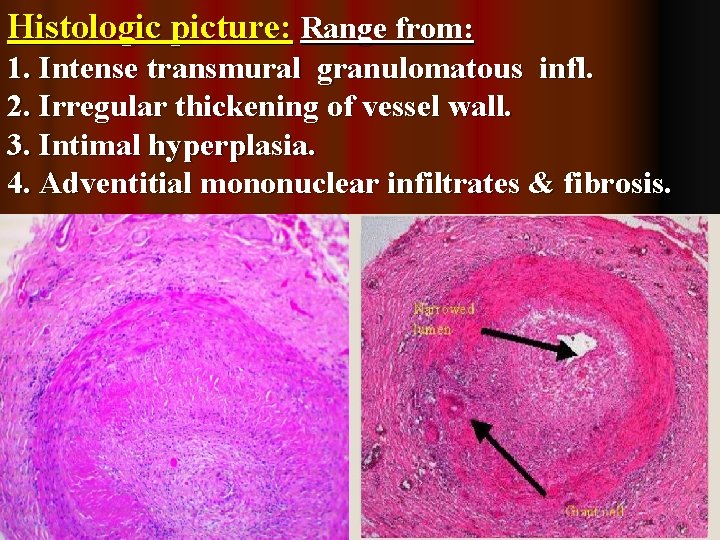 Histologic picture: Range from: 1. Intense transmural granulomatous infl. 2. Irregular thickening of vessel