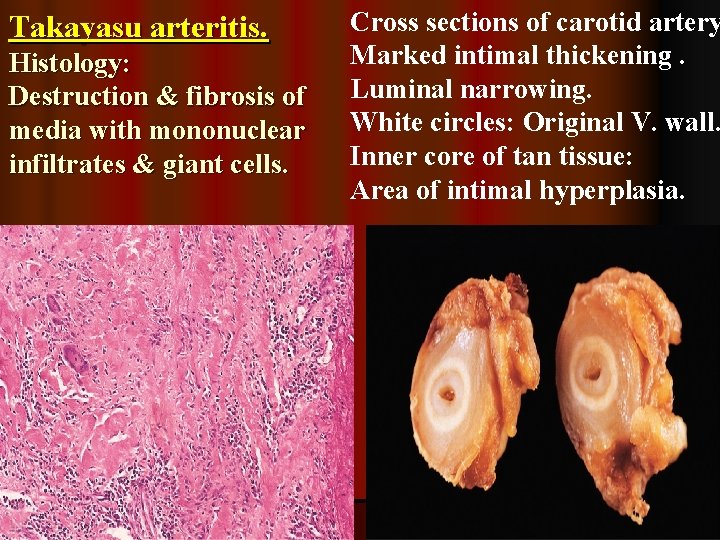 Takayasu arteritis. Histology: Destruction & fibrosis of media with mononuclear infiltrates & giant cells.