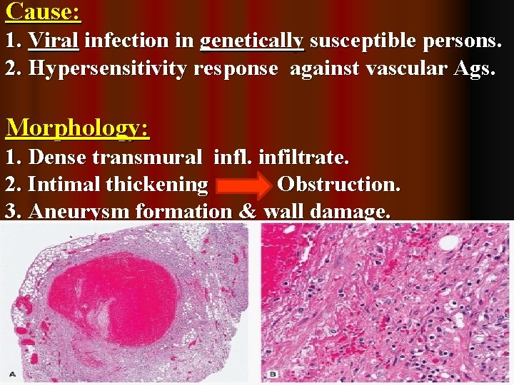 Cause: 1. Viral infection in genetically susceptible persons. 2. Hypersensitivity response against vascular Ags.