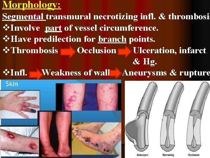 Morphology: Segmental transmural necrotizing infl. & thrombosis v. Involve part of vessel circumference. v.