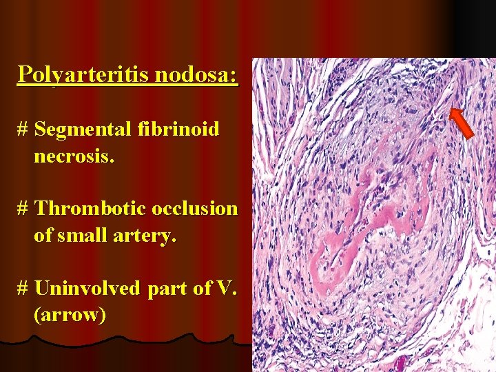 Polyarteritis nodosa: # Segmental fibrinoid necrosis. # Thrombotic occlusion of small artery. # Uninvolved