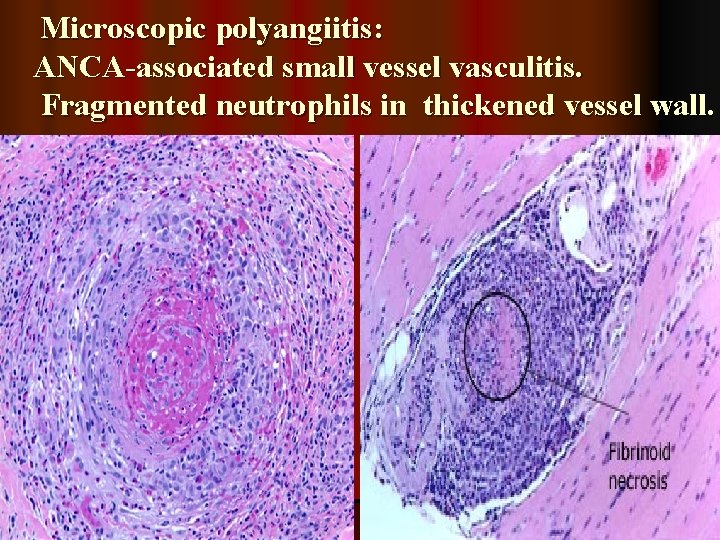Microscopic polyangiitis: ANCA-associated small vessel vasculitis. Fragmented neutrophils in thickened vessel wall. 