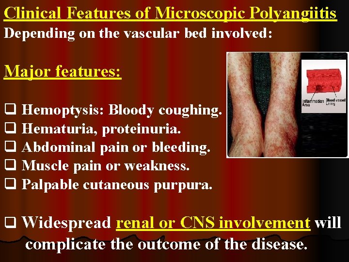 Clinical Features of Microscopic Polyangiitis Depending on the vascular bed involved: Major features: q