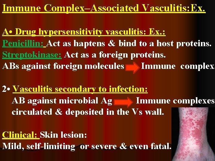 Immune Complex–Associated Vasculitis: Ex. A • Drug hypersensitivity vasculitis: Ex. : Penicillin: Act as