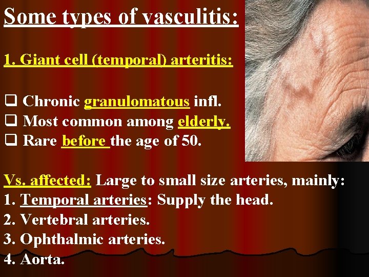 Some types of vasculitis: 1. Giant cell (temporal) arteritis: q Chronic granulomatous infl. q