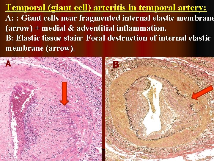 Temporal (giant cell) arteritis in temporal artery: A: : Giant cells near fragmented internal