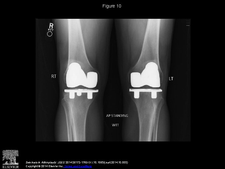 Figure 10 Seminars in Arthroplasty: JSES 2014 25172 -178 DOI: (10. 1053/j. sart. 2014.