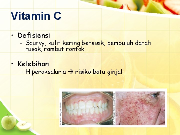 Vitamin C • Defisiensi – Scurvy, kulit kering bersisik, pembuluh darah rusak, rambut rontok