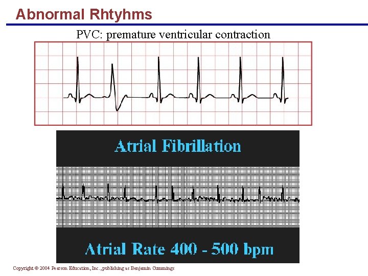 Abnormal Rhtyhms PVC: premature ventricular contraction Copyright © 2004 Pearson Education, Inc. , publishing