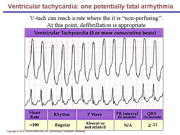 Ventricular tachycardia: one potentially fatal arrhythmia V-tach can reach a rate where the it
