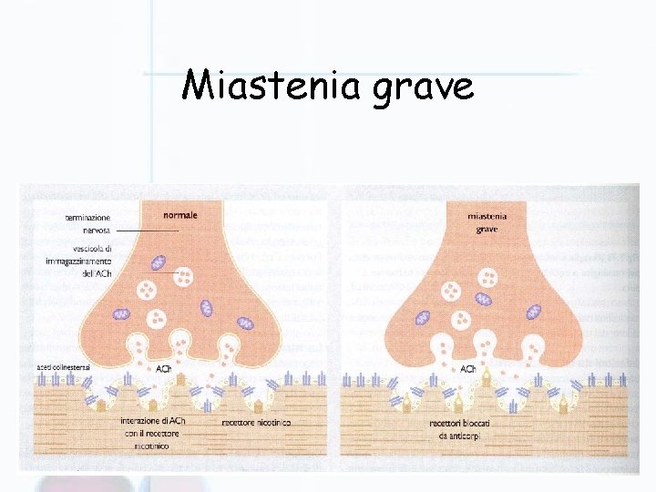 Miastenia grave 