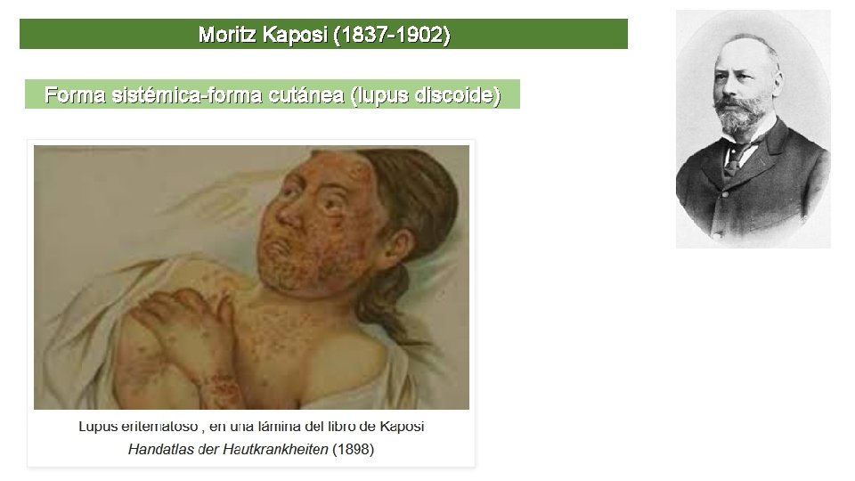 Moritz Kaposi (1837 -1902) Forma sistémica-forma cutánea (lupus discoide) 