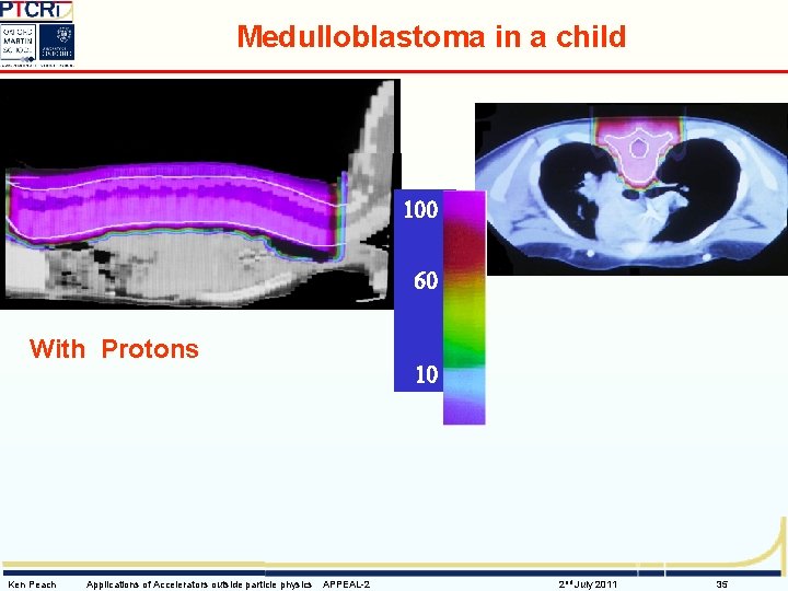 Medulloblastoma in a child X-rays 100 60 With Protons Ken Peach Applications of Accelerators