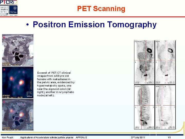 PET Scanning • Positron Emission Tomography Excerpt of PET-CT clinical images from a 69