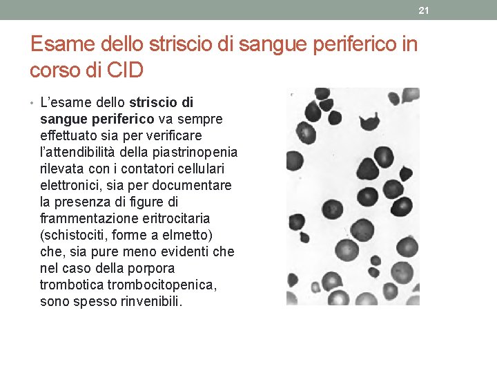 21 Esame dello striscio di sangue periferico in corso di CID • L’esame dello 21 Esame dello striscio di sangue periferico in corso di CID • L’esame dello