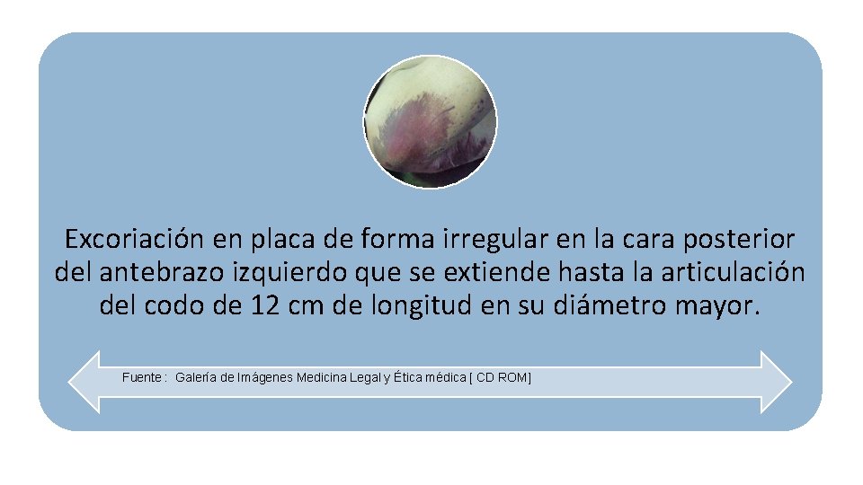 Excoriación en placa de forma irregular en la cara posterior del antebrazo izquierdo que