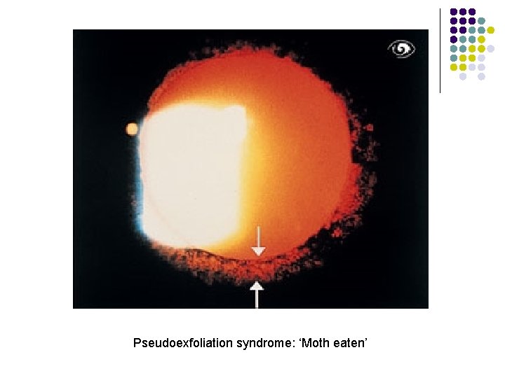 Pseudoexfoliation syndrome: ‘Moth eaten’ 