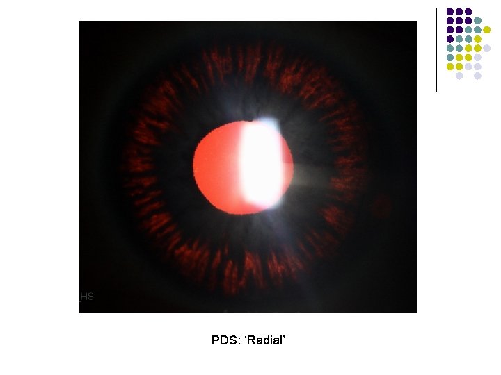 PDS: ‘Radial’ 