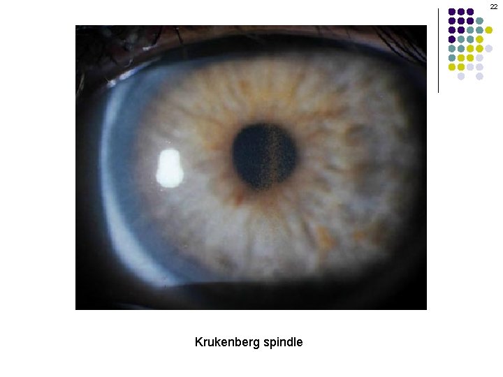 22 Krukenberg spindle 