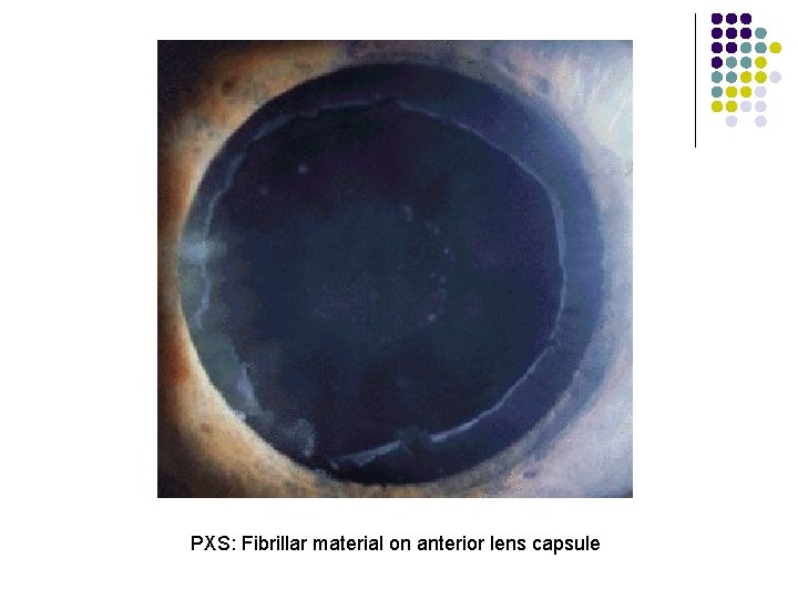 PXS: Fibrillar material on anterior lens capsule 