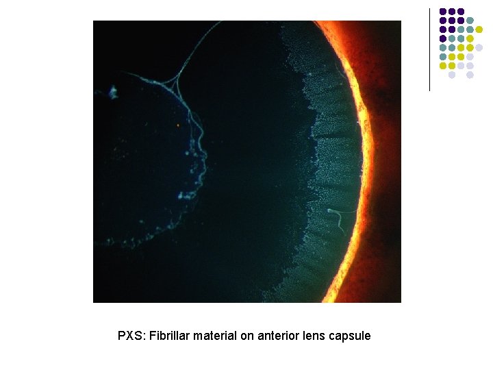 PXS: Fibrillar material on anterior lens capsule 