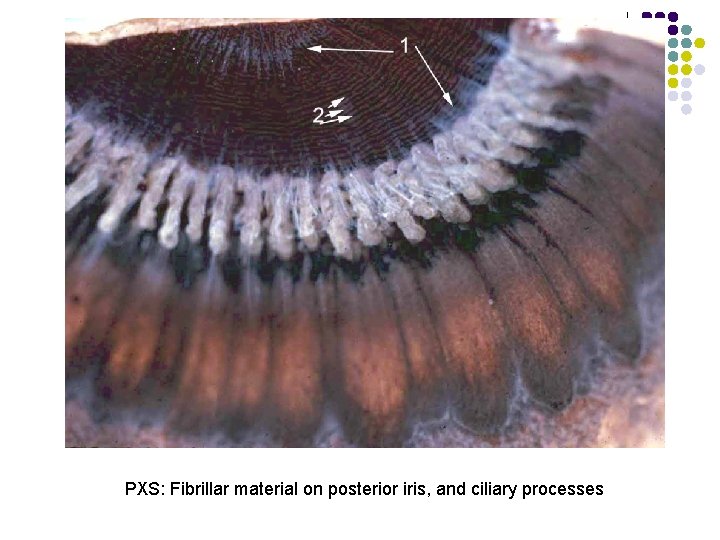 PXS: Fibrillar material on posterior iris, and ciliary processes 