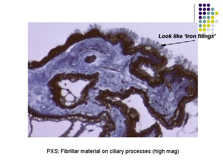 Look like ‘iron filings’ PXS: Fibrillar material on ciliary processes (high mag) 