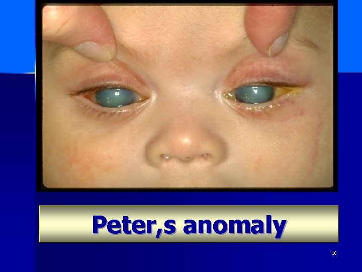 Peter, s anomaly 10 
