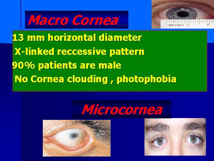 Macro Cornea 13 mm horizontal diameter X-linked reccessive pattern 90% patients are male No