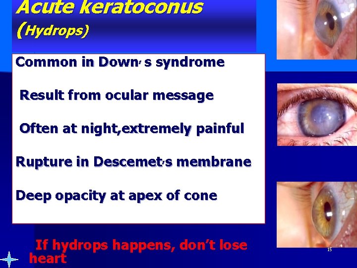 Acute keratoconus (Hydrops) Common in Down, s syndrome Result from ocular message Often at