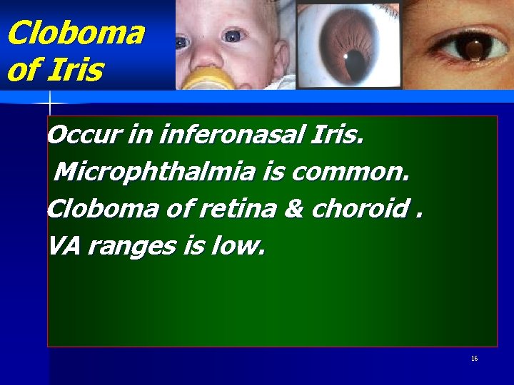 Cloboma of Iris Occur in inferonasal Iris. Microphthalmia is common. Cloboma of retina &