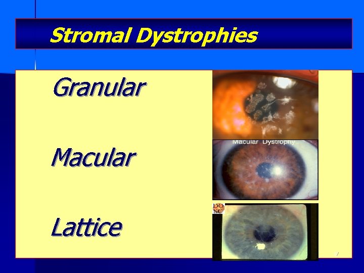 Stromal Dystrophies Granular Macular Lattice 17 