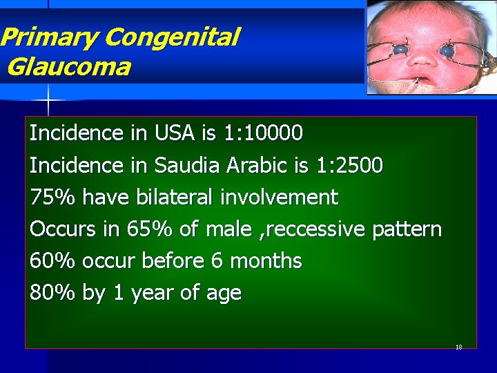 Primary Congenital Glaucoma Incidence in USA is 1: 10000 Incidence in Saudia Arabic is