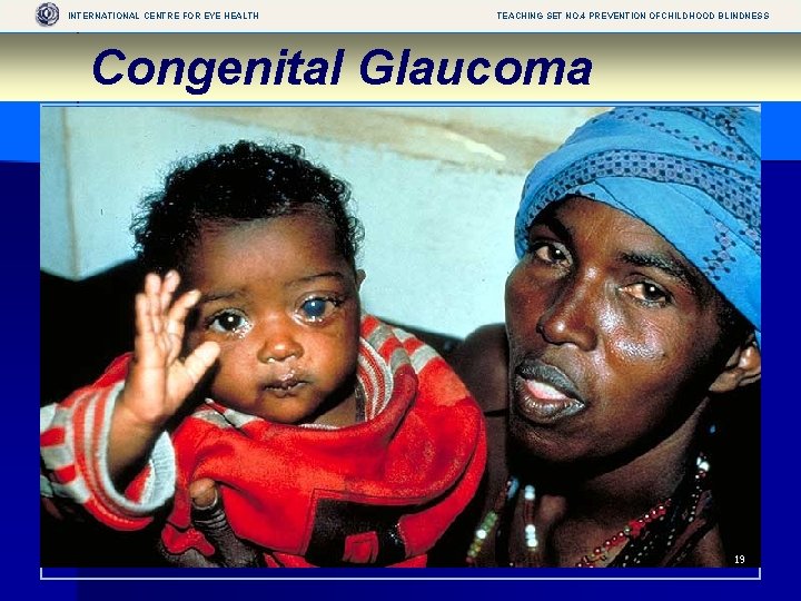 INTERNATIONAL CENTRE FOR EYE HEALTH TEACHING SET NO. 4 PREVENTION OFCHILDHOOD BLINDNESS Congenital Glaucoma