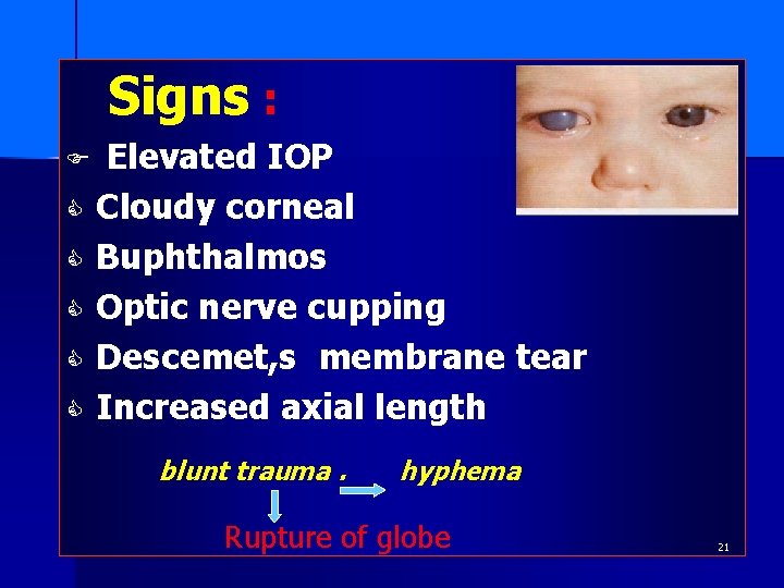 Signs : F C C C Elevated IOP Cloudy corneal Buphthalmos Optic nerve cupping