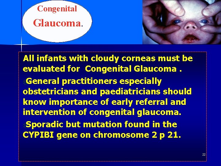 Congenital Glaucoma. All infants with cloudy corneas must be evaluated for Congenital Glaucoma. ôGeneral