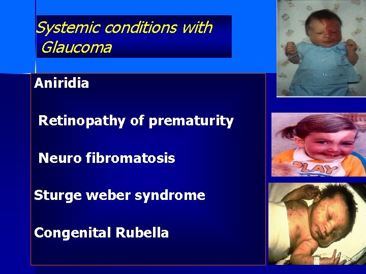 Systemic conditions with Glaucoma Aniridia Retinopathy of prematurity Neuro fibromatosis Sturge weber syndrome Congenital