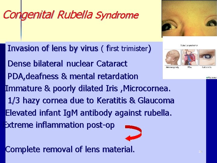 Congenital Rubella Syndrome Invasion of lens by virus ( first trimister) Dense bilateral nuclear