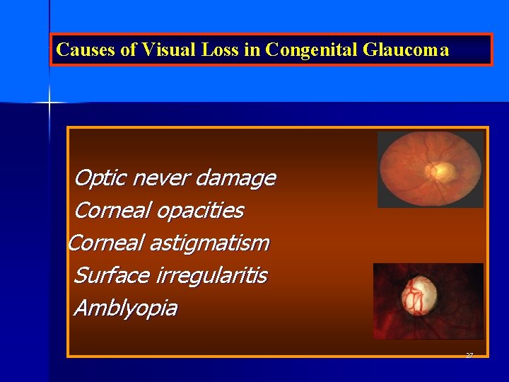 Causes of Visual Loss in Congenital Glaucoma Optic never damage Corneal opacities Corneal astigmatism