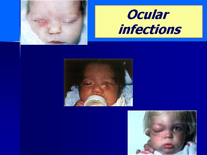 Ocular infections 33 